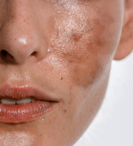 פיגמנטציה פוסט דלקתית