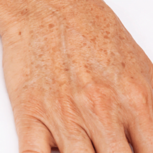 פיגמנטציה סנילית