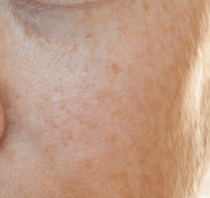 פיגמנטציה סולארית